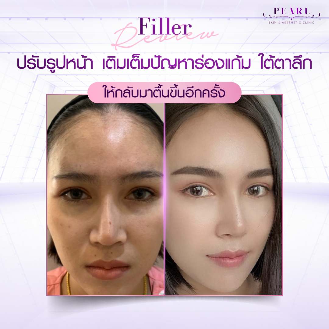 ปรับรูปหน้า-2