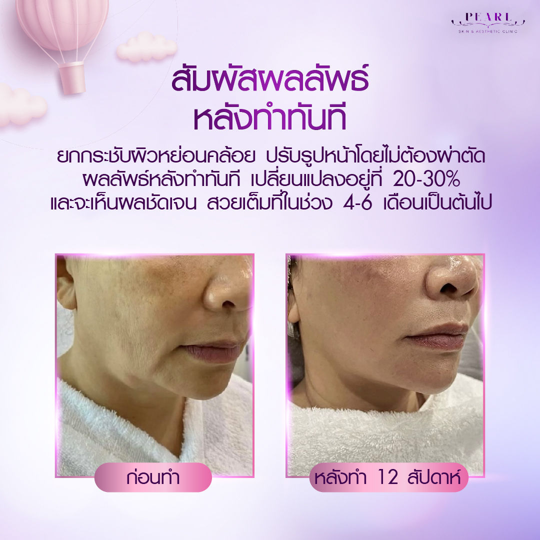 ยกกระชับ-1
