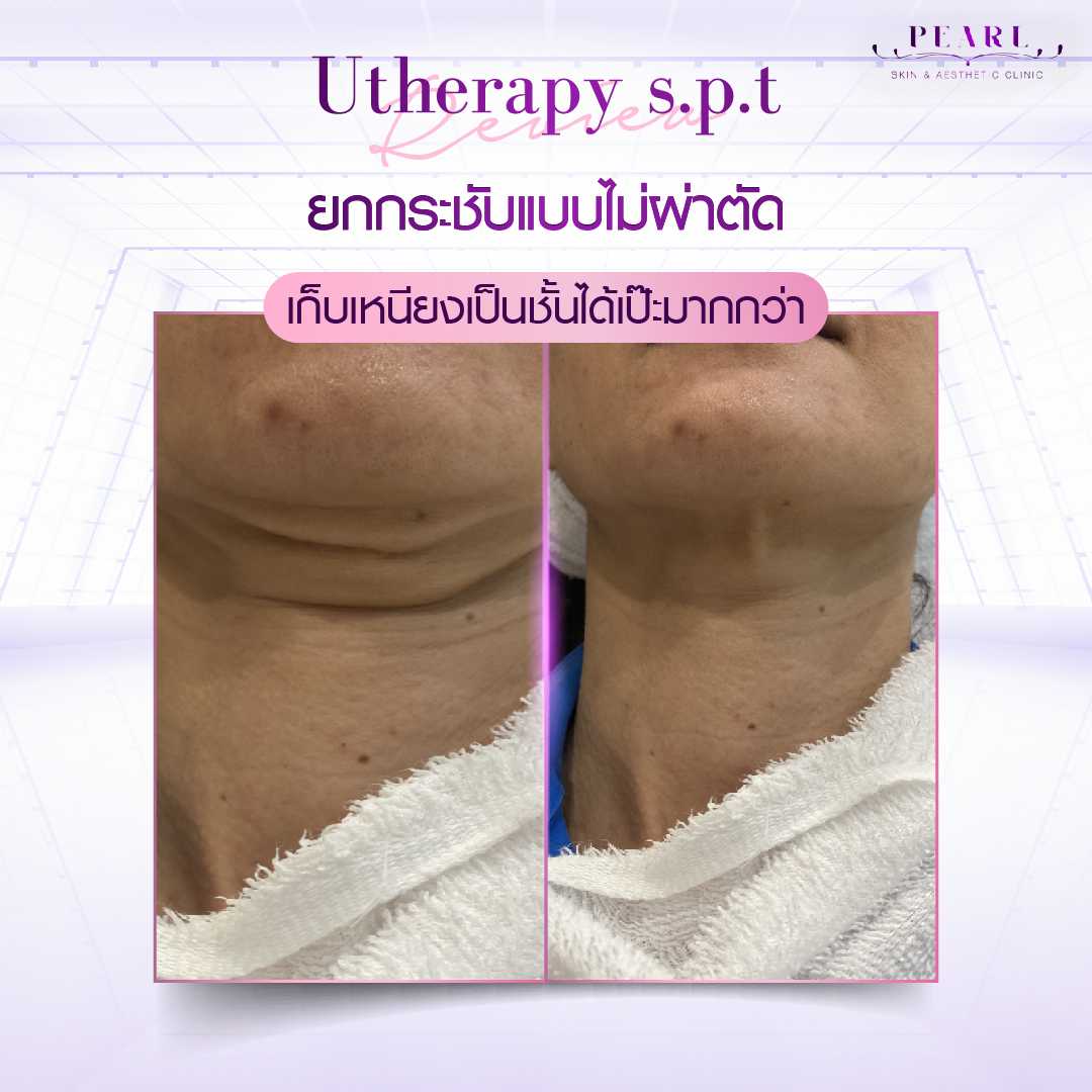 ยกกระชับ-2
