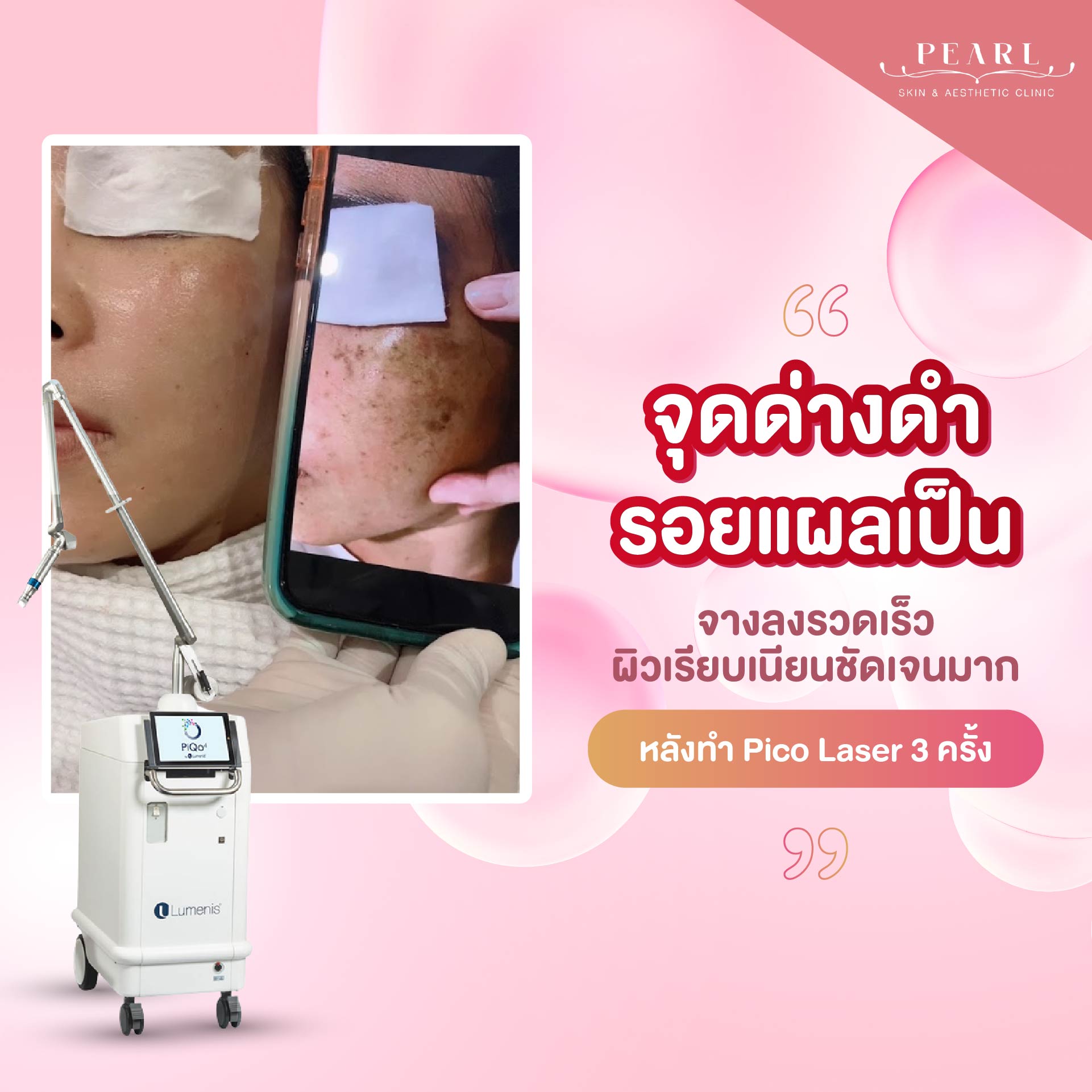 รอยดำ-2