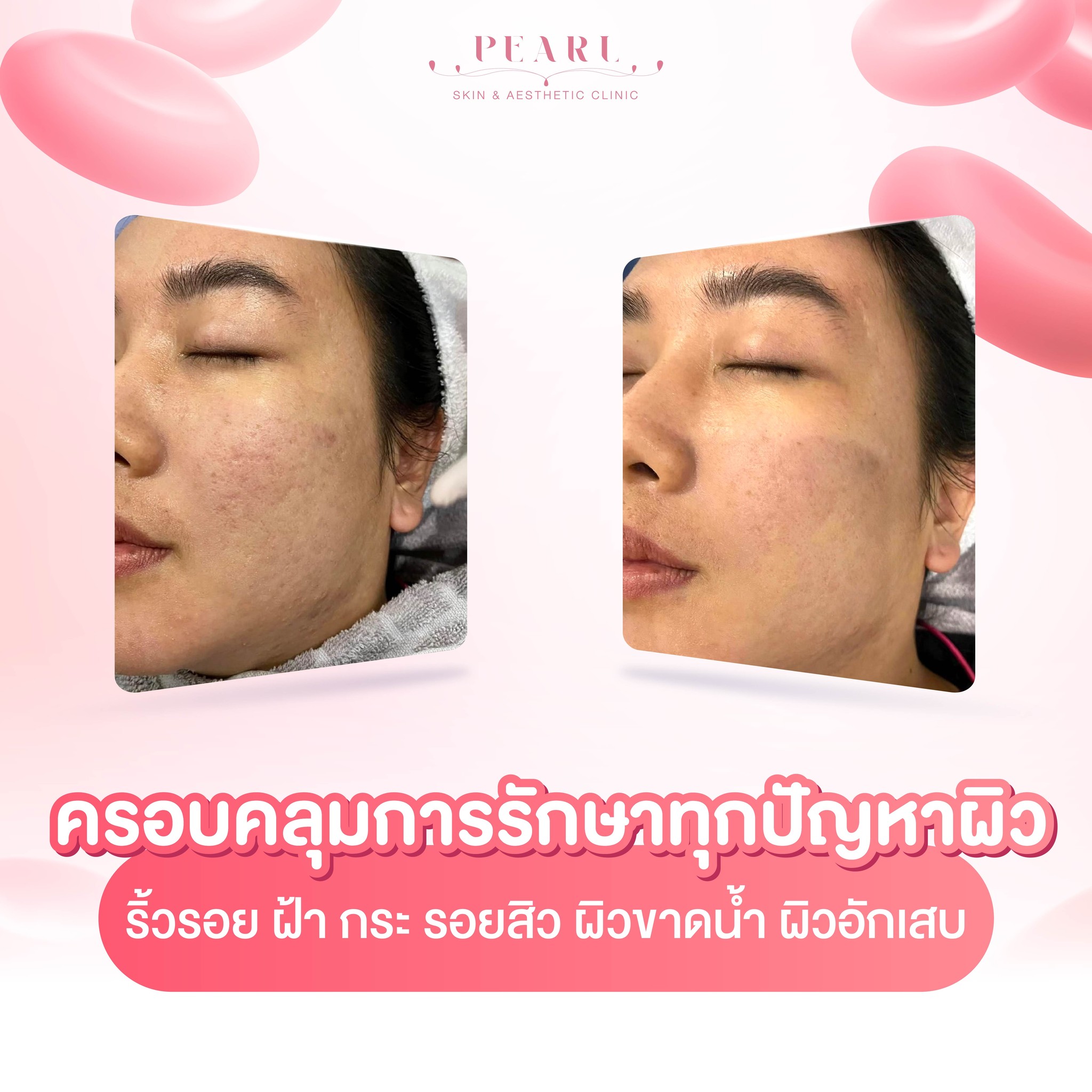 รอยดำ-3