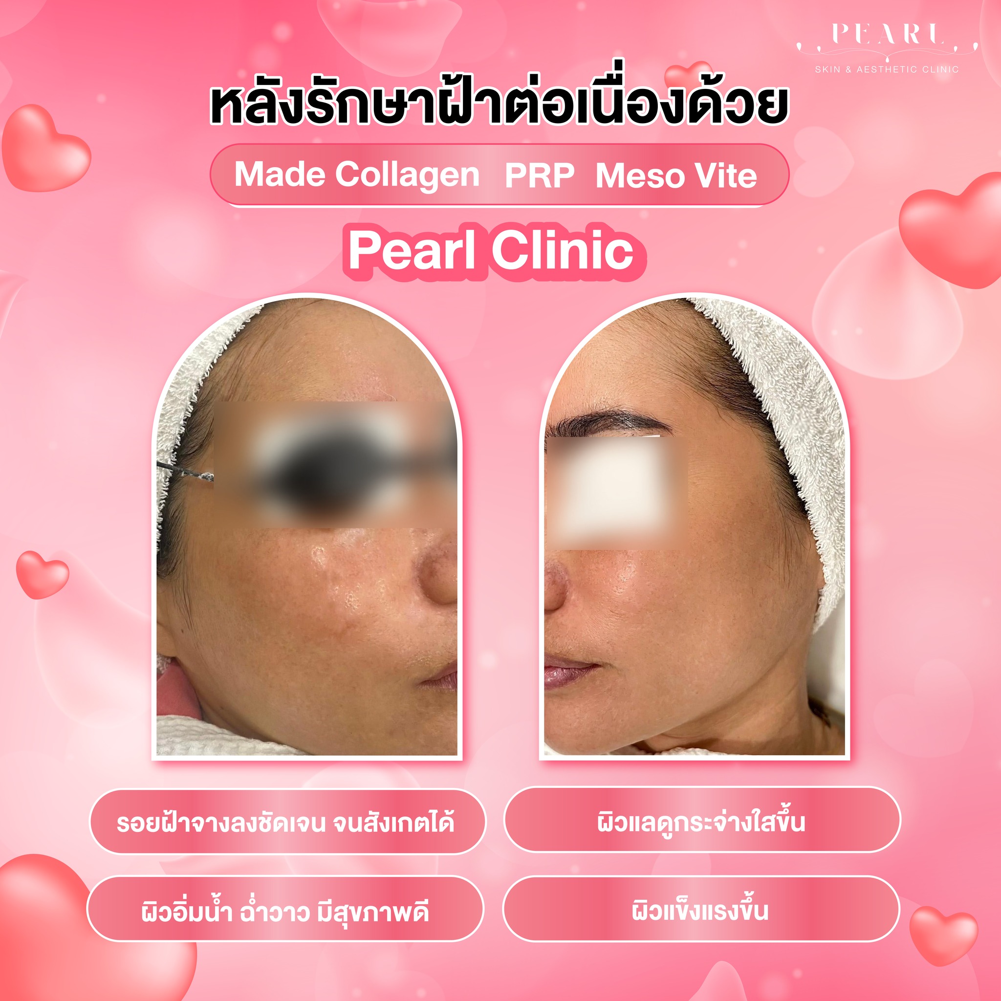 รอยดำ-4