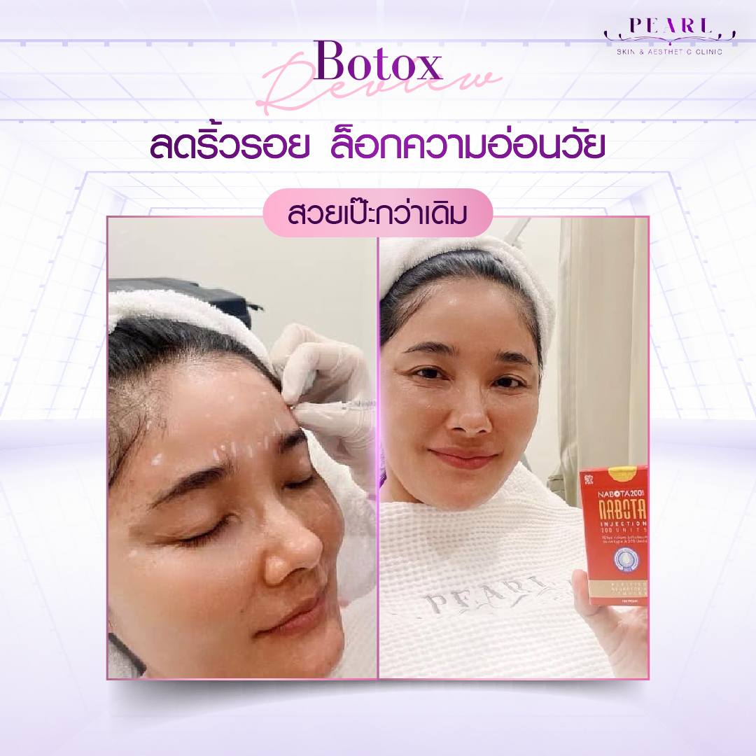 ลดริ้วรอย-01